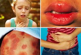 collage of anaphylaxis symptoms