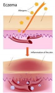 mechanics of eczema