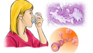 Asthma feature image