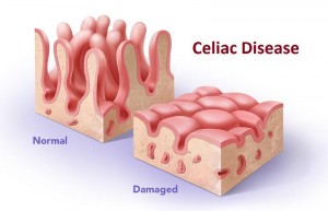 celiac-disease_0177ac66208d5826963c65f8b2c56426