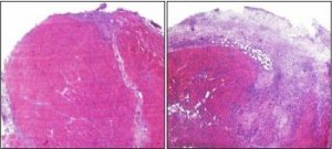 Αυτή είναι μια εγκάρσια τομή τραυματισμένου μυϊκού ιστού.  Με ροζ χρωματίζεται ο υγιής ς και με μωβ ο ουλώδης ιστός. Και τα δύο ποντίκια γενετικά στερούνται Τ κύτταρα, Στο ποντίκι αριστερά έγινε έγχυση Τ λεμφοκυττάρων που μετατράπηκαν σε ΤΗ2 κύτταρα τα οποία επιτάχυναν τη διαδικασία επούλωσης