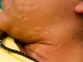 face-and-neck-urticaria-800x533-jpg